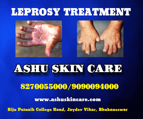 best leprosy treatment clinic in bhubaneswar, odisha
